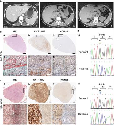 Recurrence of Primary Aldosteronism 10 Years After Left Adrenalectomy for Aldosterone-Producing Adenoma: A Case Report